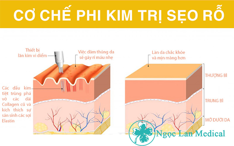 Cơ chế của phi kim trị sẹo