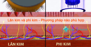 Lăn kim và phi kim - phương pháp nào phù hợp cho làn da của bạn