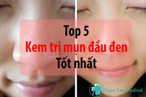 Top 5 sản phẩm trị mụn đầu đen tốt nhất